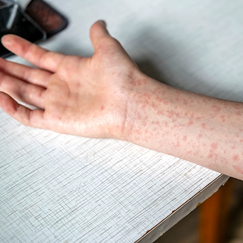 East Tennessee has more measles cases. Health officials won’t say where