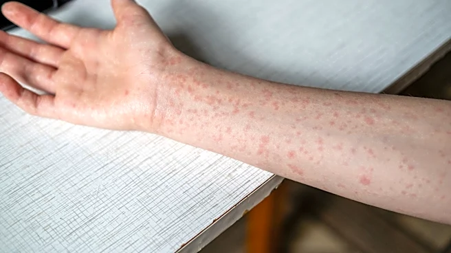 East Tennessee has more measles cases. Health officials won’t say where