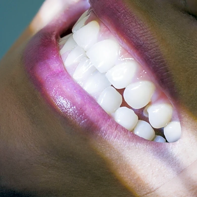 Study Explores Aesthetic Preferences for Maxillary Incisor Inclination in Smiling Profiles