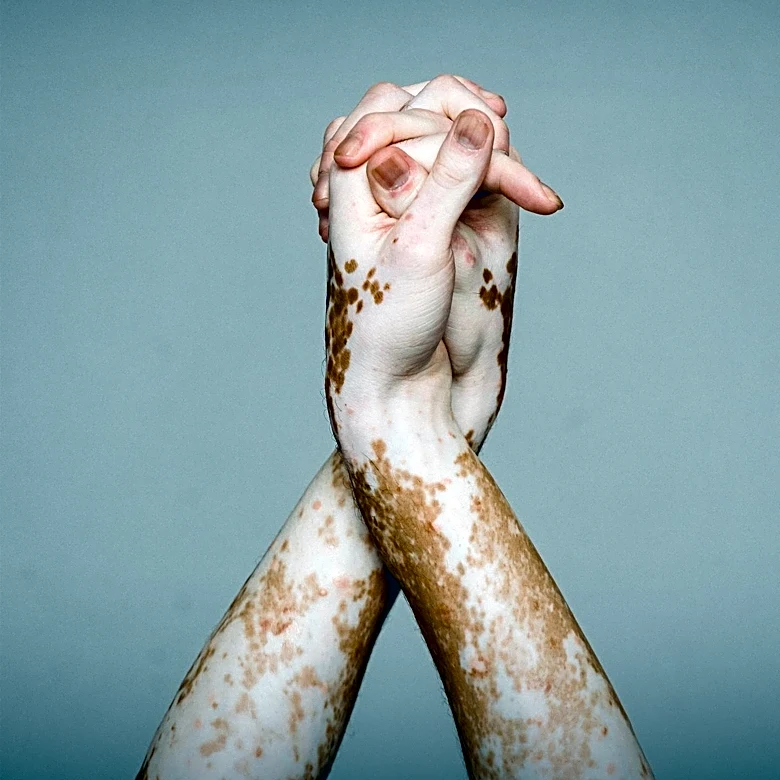 Roxanne Khamsi Explores Genetic Mosaics and Health Implications