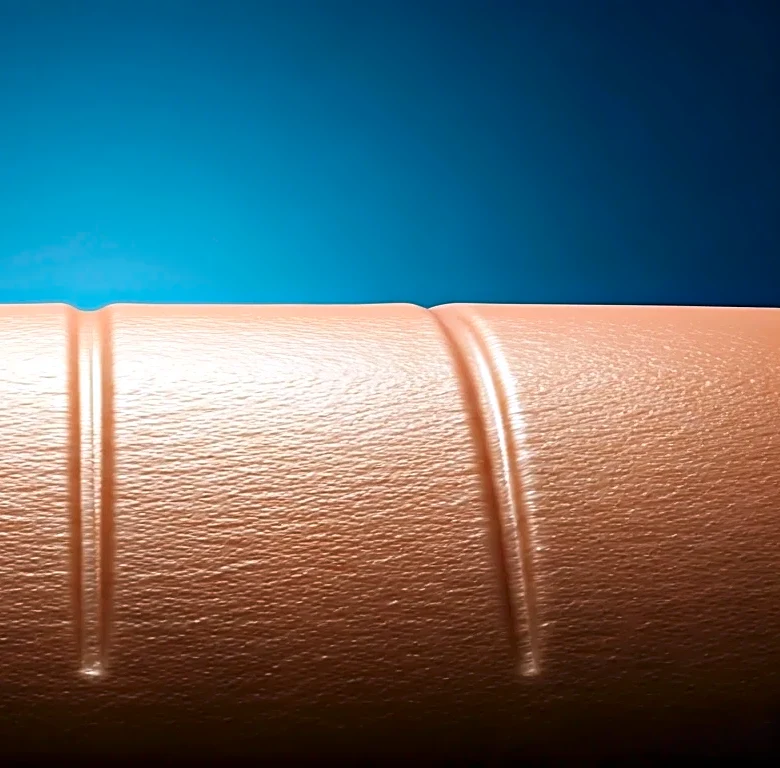 Why Most Americans Misread RF microneedling