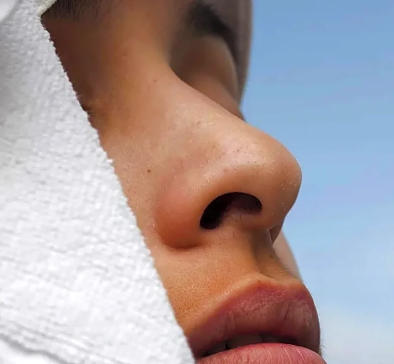 Why Treating Forehead Lines Matters More in Your 40s Than Your 20s