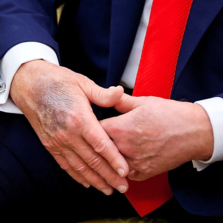 White House releases Trump's physical results, says he's in 'excellent health' but almost obese