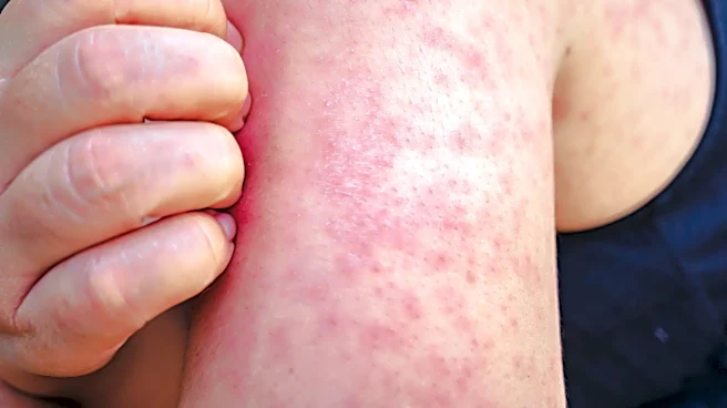 Universal Studios Hollywood visitors may have been exposed to measles