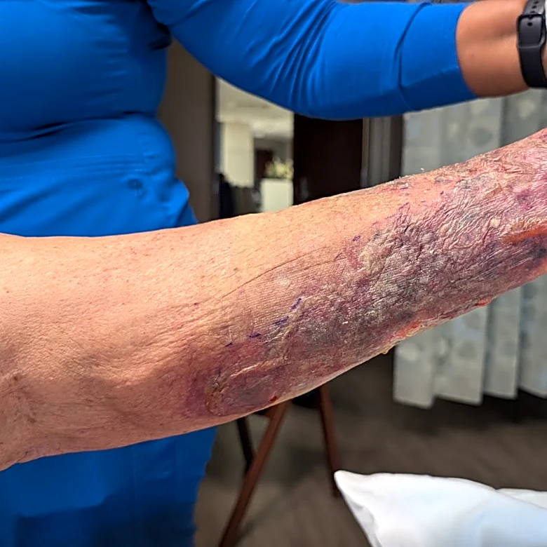 5 dead from rare flesh-eating bacteria in Louisiana