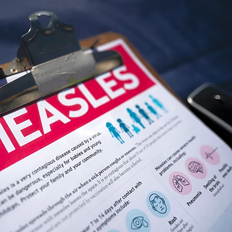 Pittsburgh reports first case of measles. See exposures, US data
