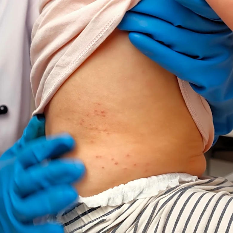 PA measles spread to Westmoreland, Butler; new cases up by nearly 100