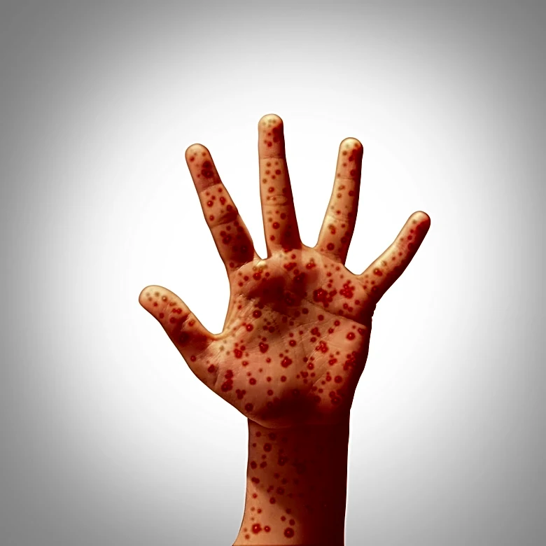 Fourth measles-associated death reported in Pennsylvania outbreak