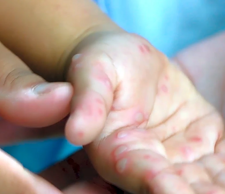 Measles cases rise across Pennsylvania. What about in Allegheny?
