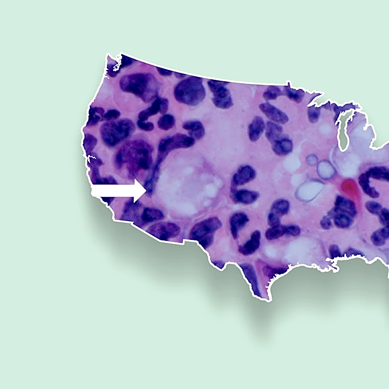 Brain-eating amoeba map shows which states have the most cases