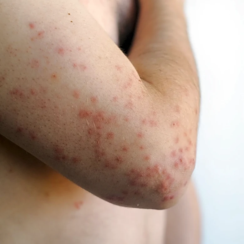 Why CDC counts only 1 measles death while Pennsylvania reports 4