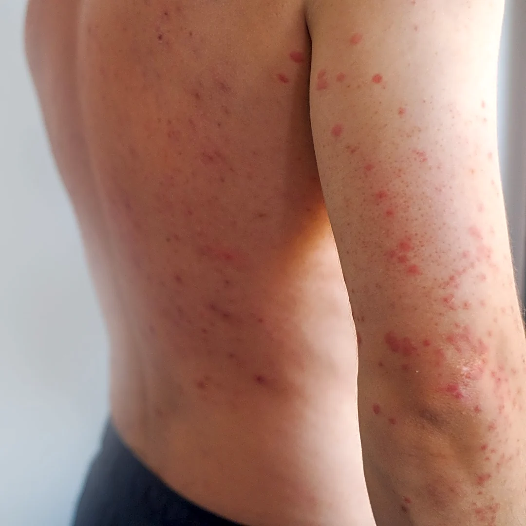 Measles cases nearly double last year's high. See where cases are up