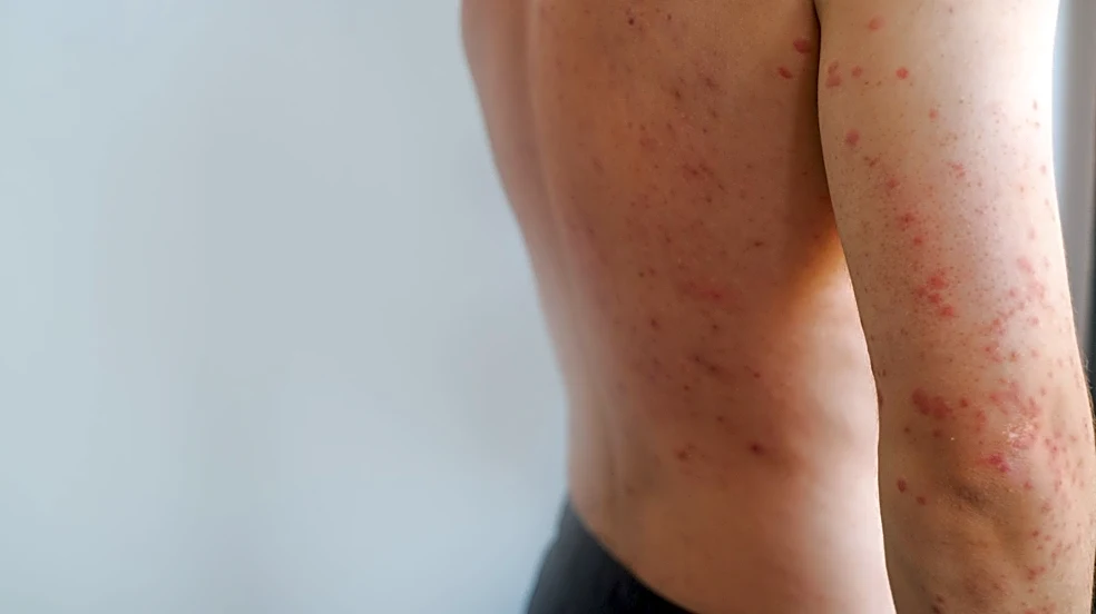 Measles cases nearly double last year's high. See where cases are up