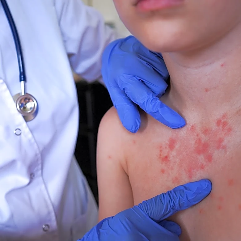 Connection found in Ventura County, Santa Barbara County measles cases