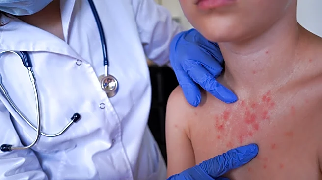 Connection found in Ventura County, Santa Barbara County measles cases